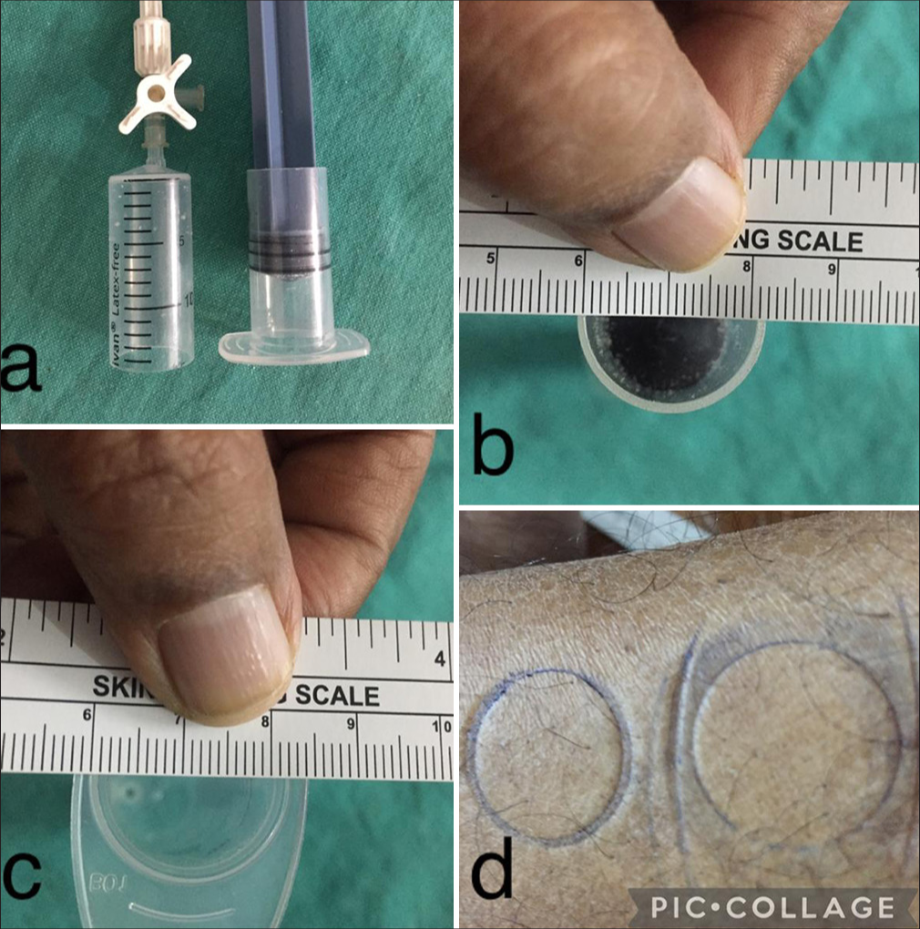 (a) Two suction devices are made with 1 disposable syringe. The differences in the diameter of (b) cup, (c) suction syringe, and (d) its impressions on the skin.