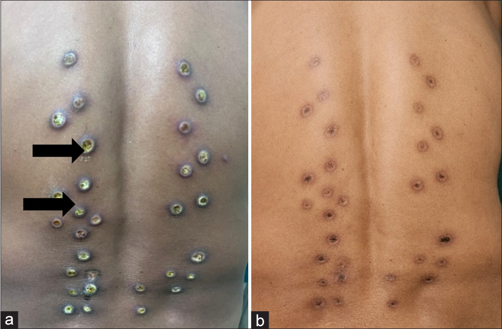 (a) Multiple infected ulcers with regular and raised borders and central slough over the lower back. (b) Healed ulcers with post-inflammatory hyperpigmentation.