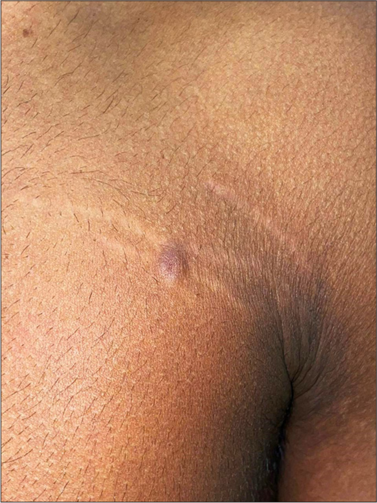 Skin-colored papule with bluish tinge on striae distensae.