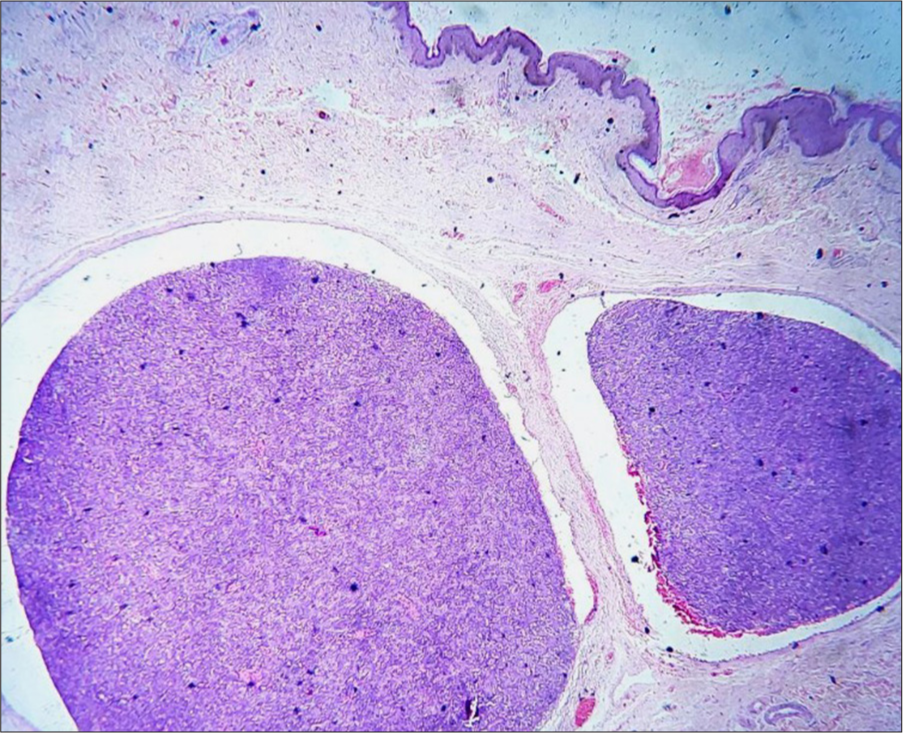 Multiple basophilic tumor lobules surrounded by capsule, hematoxylin and eosin ×40.