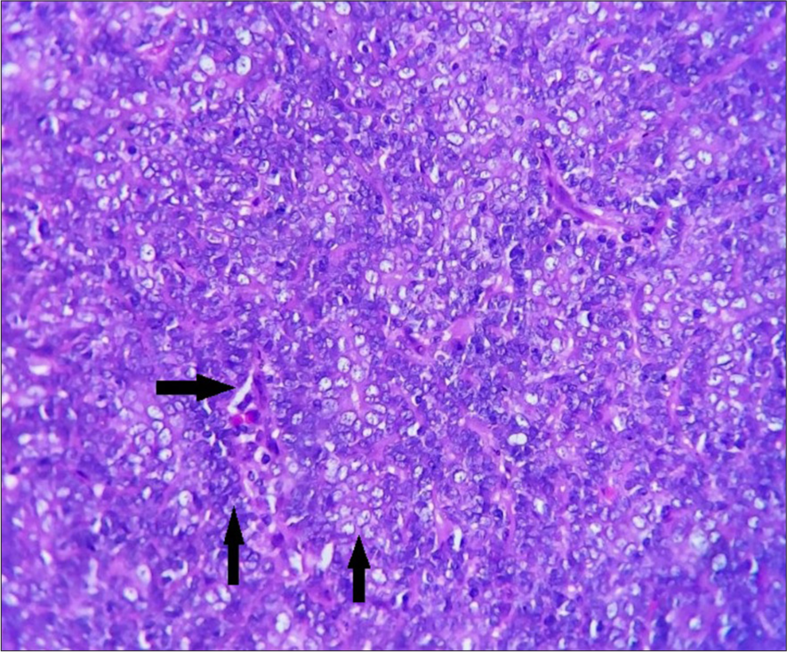 High power showing cells with basophilic nuclei (left vertical arrow) and cells with pale staining nuclei (right vertical arrow) and ductal structures (horizontal arrow), hematoxylin and eosin ×400.