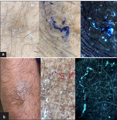 (a) Under Ultraviolet fluorescence dermoscopy (UVFD), scabies burrows appear as bright bluish serpiginous lesions (Dermlite DL5, ×10 magnification; Polarized and Ultraviolet [UV] mode). (b) The larval tracks of cutaneous larva migrans are more clearly visualized under UVFD (Dermlite DL5, ×10 magnification; Polarized and UV mode).