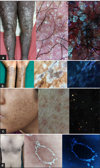 (a) Psoriasis vulgaris exhibits a pinkish-red fluorescence under Ultraviolet fluorescence dermoscopy (UVFD) (Dermlite DL5, ×10 magnification; Polarized and Ultraviolet [UV] mode). (b) Wickham’s striae in lichen planus are visible under UVFD (Dermlite DL5, ×10 magnification; Polarized and UV mode). (c) In acne vulgaris, follicular reddish fluorescence (indicating cutibacterial colonization) manifests as follicular blackouts (Dermlite DL5, ×10 magnification; Polarized and UV mode). (d) The peripheral collarette of pityriasis rosea is observed under UVFD (Dermlite DL5, ×10 magnification; Polarized and UV mode).