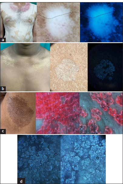 (a) The borders of lesions in vitiligo are better delineated under Ultraviolet fluorescence dermoscopy (UVFD) (Dermlite DL5, ×10 magnification; Polarized and Ultraviolet [UV] mode). (b) Tinea versicolor displays a greenish fluorescence under UVFD (Dermlite DL5, ×10 magnification; Polarized and UV mode). (c) Erythrasma is characterized by a coral red diffuse and perifollicular fluorescence (Dermlite DL5, ×10 magnification; UV mode). (d) Bluish chalky white fluorescence is seen in terra firmaforme dermatosis under UVFD (Dermlite DL5, ×10 magnification; UV mode).