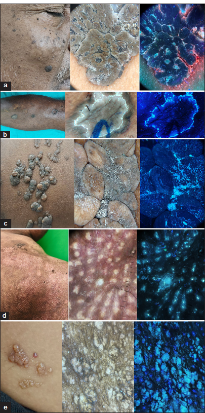 (a) Comedonal plugs and milia-like cysts in seborrheic keratosis are enhanced by Ultraviolet fluorescence dermoscopy (UVFD), often referred to as the Ultraviolet (UV) blink sign (Dermlite DL5, ×10 magnification; Polarized and UV mode). (b) The double-edged rim in porokeratosis (coronoid lamella) is visualized as bright bluish fluorescence under UVFD (Dermlite DL5, ×10 magnification; Polarized and UV mode). (c) Keratotic debris and comedonal plugging in nevus lipomatosus are more apparent under UVFD (Dermlite DL5, ×10 magnification; Polarized and UV mode). (d) Sebaceous hyperplasia is better visualized with UVFD, where sebum extrusion appears as yellowish or bluish fluorescent material (Dermlite DL5, ×10 magnification; Polarized and UV mode). (e) Bluish fluorescence observed in microcystic lymphatic malformation under UVFD (Dermlite DL5, ×10 magnification; Polarized and UV mode).