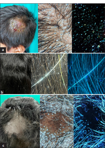 (a) Bright green fluorescence of tinea capitis is evident under Ultraviolet fluorescence dermoscopy (UVFD) (Dermlite DL5, ×10 magnification; Polarized and Ultraviolet [UV] mode). (b) Premature canities is better visualized with UVFD (Dermlite DL5, ×10 magnification; Polarized and UV mode). (c) In lichen planopilaris, the absence of normal follicular fluorescence indicates scarring alopecia (Dermlite DL5, ×10 magnification; Polarized and UV mode).