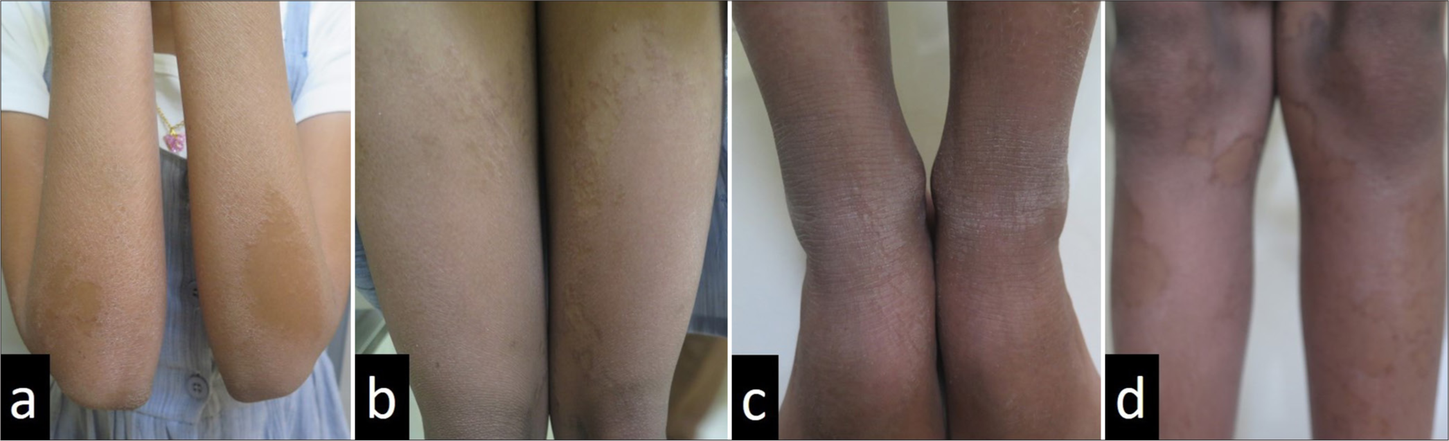 A 12-year-old girl with bilaterally symmetrical thin erythematous and keratotic plaques with peripheral scaling over both extensor (a) upper and (b-d) lower limbs.