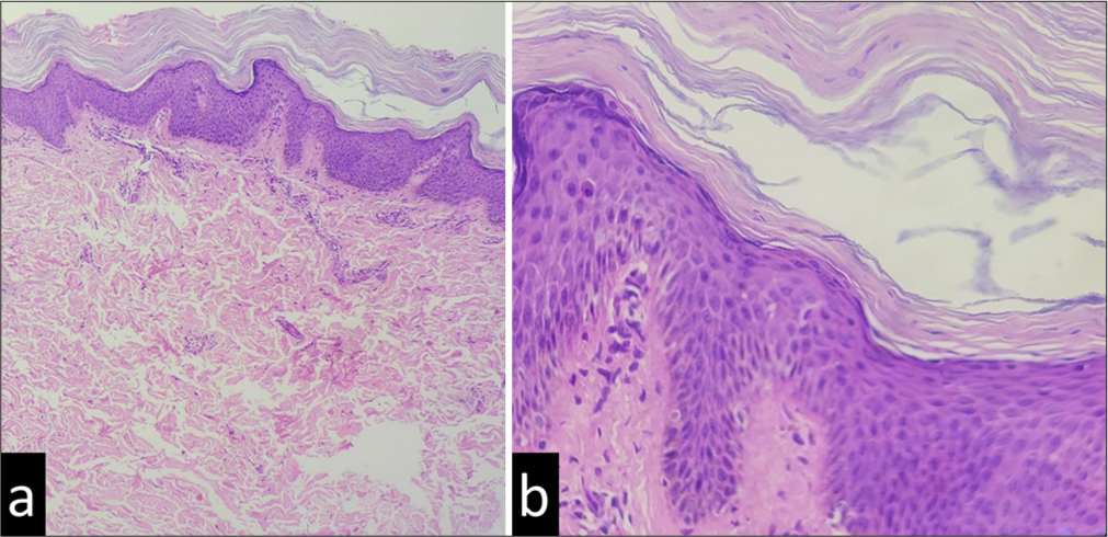 (a) Irregular psoriasiform hyperplasia of the epidermis and sparse superficial perivascular infiltrate (hematoxylin and eosin [H and E], ×100), and (b) A clear orthokeratosis of the stratum corneum and foci of parakeratosis, focal hyper-granulosis and sparse dermal lymphocytic infiltrate and dilated papillary dermal capillaries which are suggestive of erythrokeratoderma (H and E, ×400).