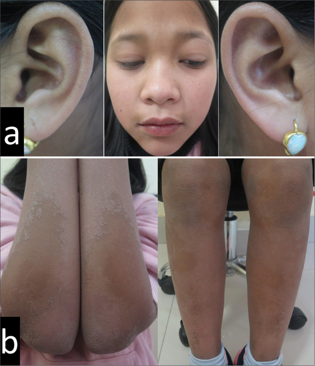 After six months of being on oral isotretinoin, there was good improvement of the (a) face with persistence and aggravation of the (b) forearm and leg plaques.