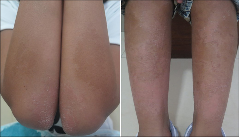 Six months after restarting oral isotretinoin, patient can be seen to have satisfactory results on the upper limbs, but not the lower limbs.