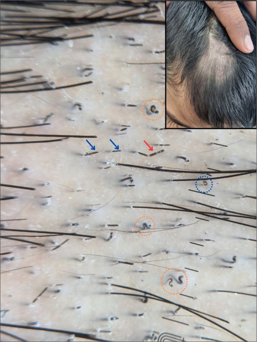 Trichoscopy showing corkscrew hairs (orange circle), horse-shoe hair (blue circle), Morse-code hair (red arrow), and block hairs (blue arrows). The inset shows the clinical image of the same patient (×20, DermLite DL5, polarized, contact, dry).
