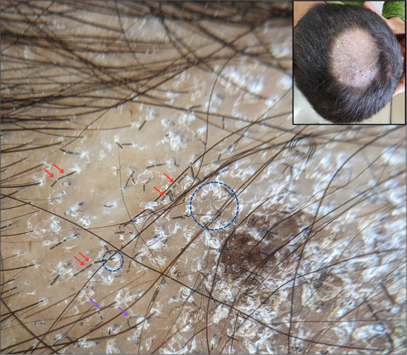 Trichoscopy showing diffuse and perifollicular scaling (blue circle) along with Morse-code hairs (red arrows) and zigzag hairs (purple arrows). The inset shows the clinical image of the same patient (×20, DermLite DL5, polarized, contact, dry).
