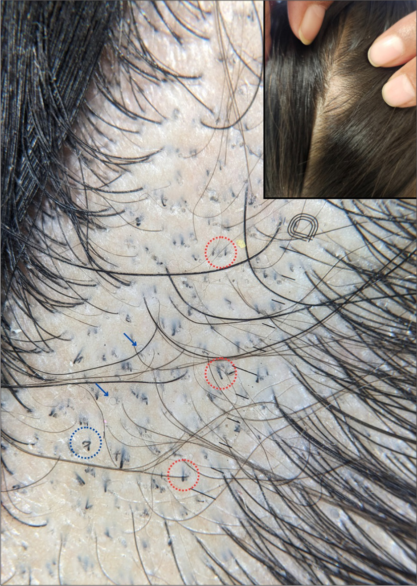 Trichoscopy showing i-hairs (red circles), pigtail hairs (blue arrows), and horse-shoe hair (blue circle). The inset shows the clinical image of the same patient (×20, DermLite DL5, polarized, contact, dry).