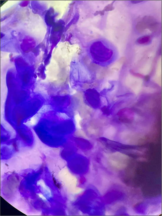 Tzanck smear showing multinucleated giant cells, a hallmark of viral cytopathic effect, confirming varicella-zoster virus infection.