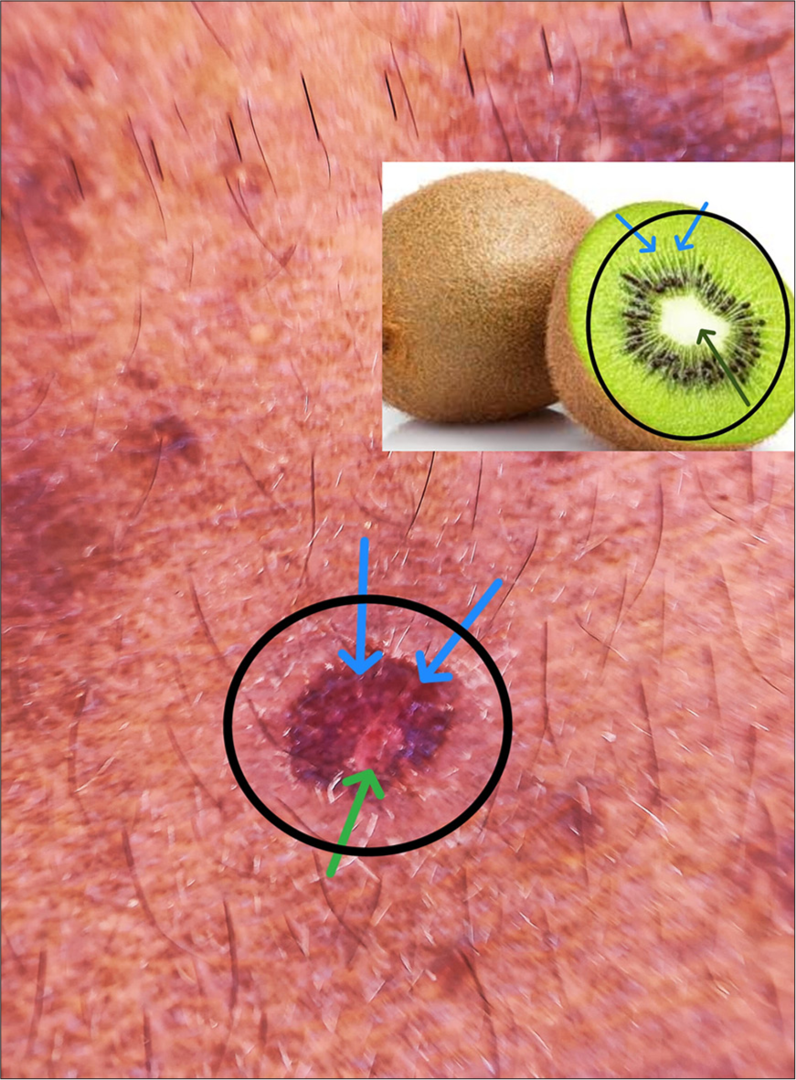 Dermoscopic examination showing, three distinct zones with an innermost zone of hypopigmentation (green arrow), middle zone of light brown hyperpigmentation with radial white colored streaks (blue arrow), and an outer zone of rim of hypopigmentation (black circle) giving rise to an appearance resembling a cut section of kiwi fruit. Inset image showing cut section of kiwi fruit with central white area (black arrow) and radiating white streaks (blue arrow).