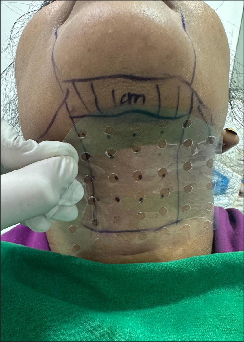 A designed template is used to mark the procedural site in injection lipolysis.