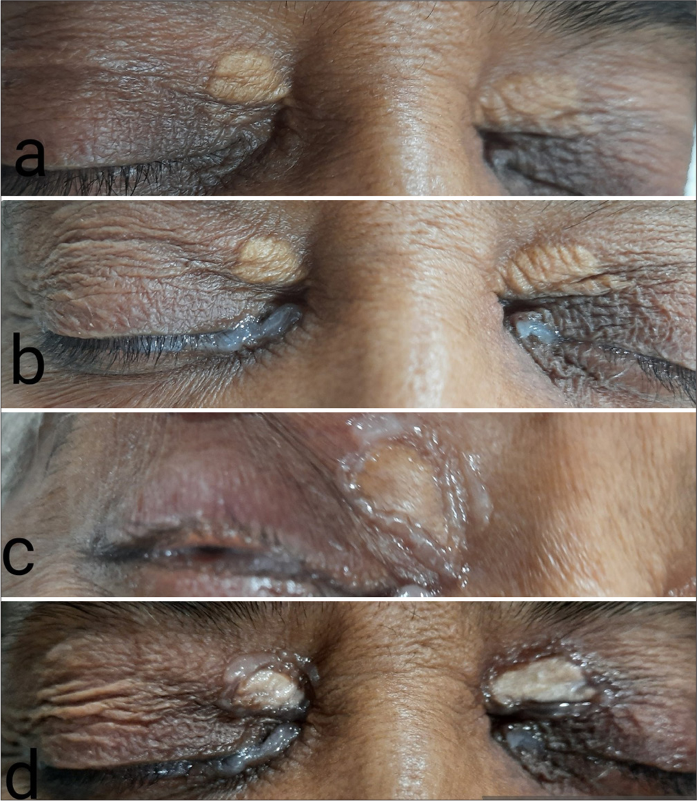 (a) Xanthelasmas without ointment. (b) Application of the ointment to the eyeball before cautery. (c) Application of the ointment on the lesion’s margin. (d) Trichloroacetic acid cauterized xanthelasma lesions.