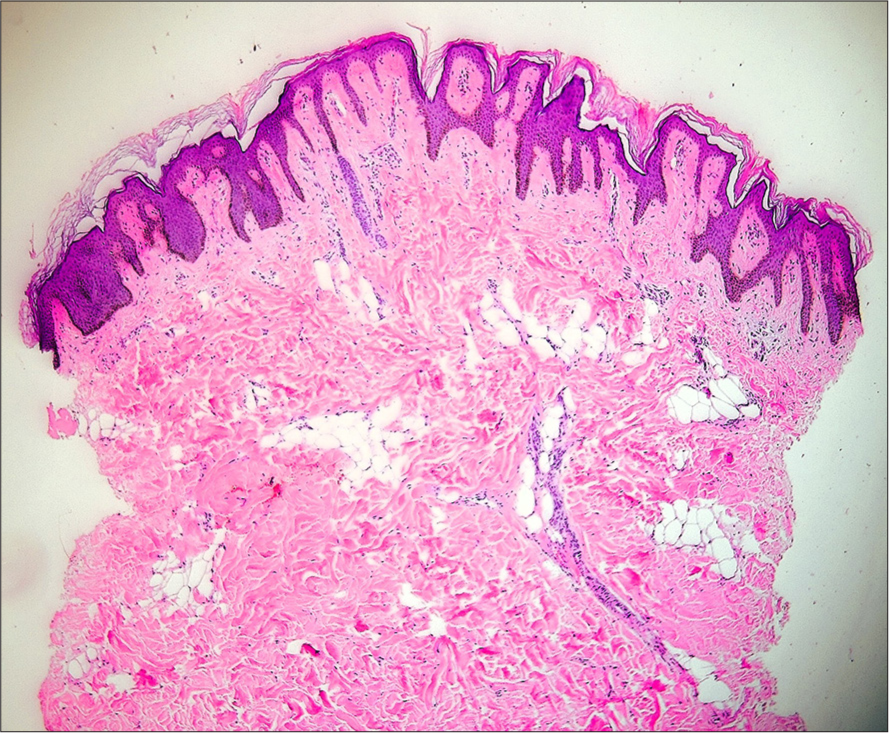 Histopathology of nevus lipomatosus showing mild hyperkeratosis, papillomatosis, epidermal acanthosis, and the presence of multiple mature adipocytes in reticular dermis with no connection to subcutaneous fat (hematoxylin and eosin, ×40).