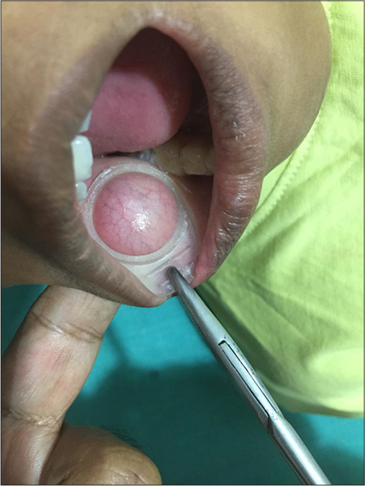 The ring is applied to normal buccal mucosa.