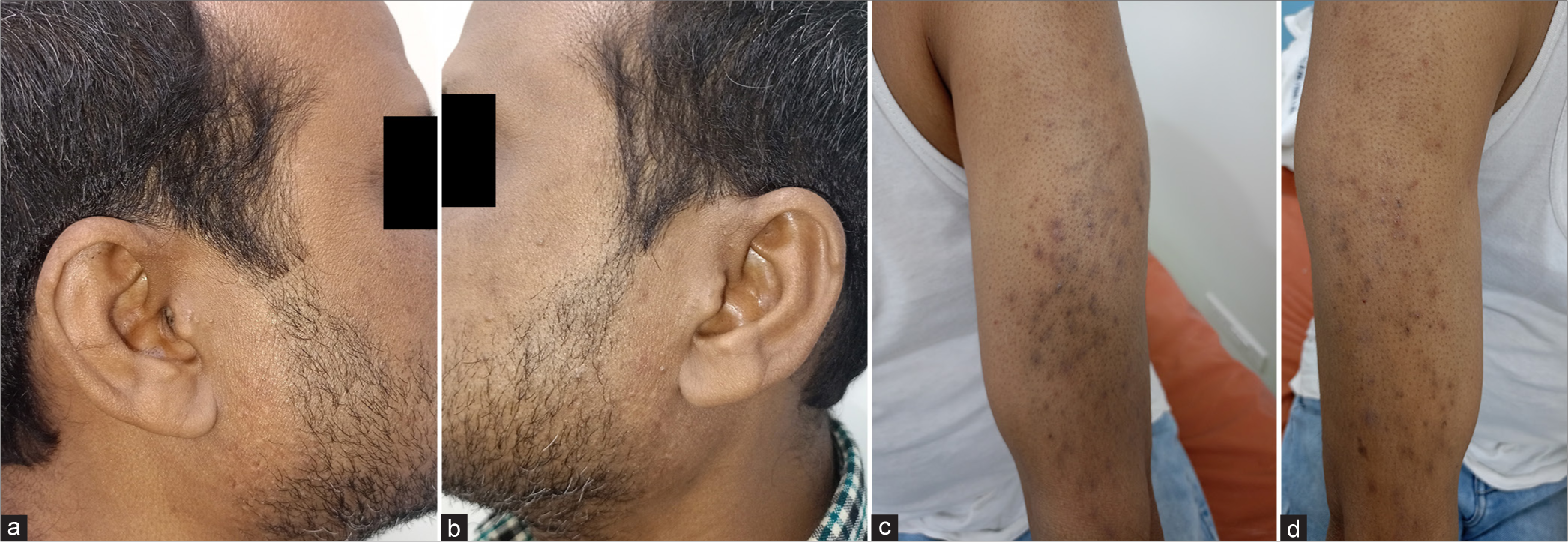 (a and b) Complete resolution of the face lesion after 3 months. (c and d) Complete improvement of the skin lesion over bilateral arms after 3 months with residual post-inflammatory hyperpigmentation.