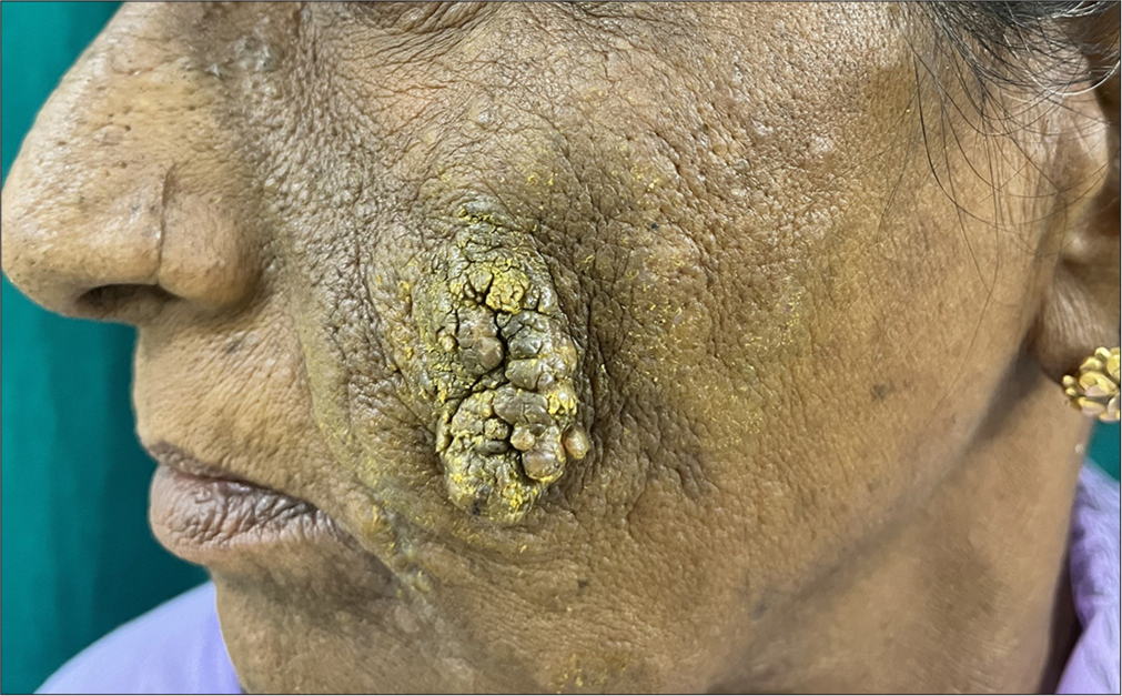 A single well-defined skin-colored to hyperpigmented mammilated exophytic nodule of size 4 × 2 cm with the surface showing nodularity and verrucous changes over her left cheek. A few areas appear with a yellowish tint secondary to turmeric application.